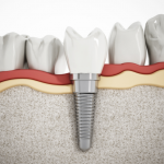 dental implants in woodbridge